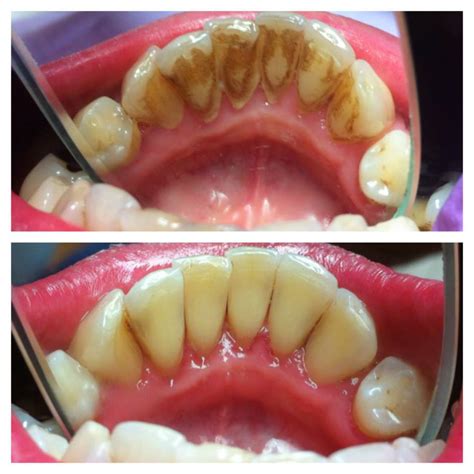 PERIODONTICS | Stomatolog Patricia