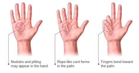 Dupuytren Contracture: Causes, Symptoms, Treatment and Exercises | Rebalance Sports Medicine