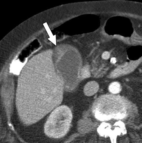 CT Differentiation of Adenomyomatosis and Gallbladder Cancer | AJR