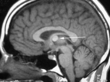 Brain Imaging in Colloid Cyst: Practice Essentials, Computed Tomography ...