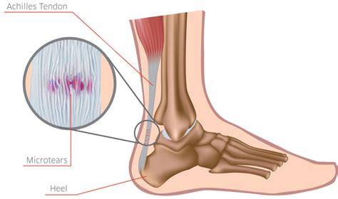 Achilles Tendinopathy; What is it? What can I do about it? - Podiatry First