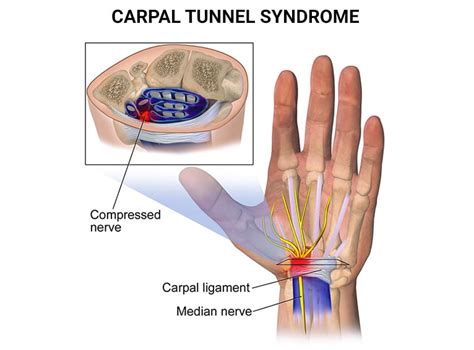 Carpal Tunnel Syndrome Treatment NYC | Hand Pain in New York