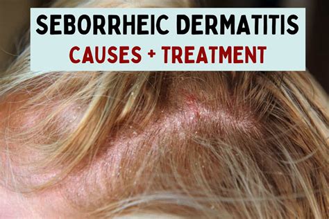 Seborrheic Dermatitis (Dandruff And Cradle Cap) Causes,, 47% OFF