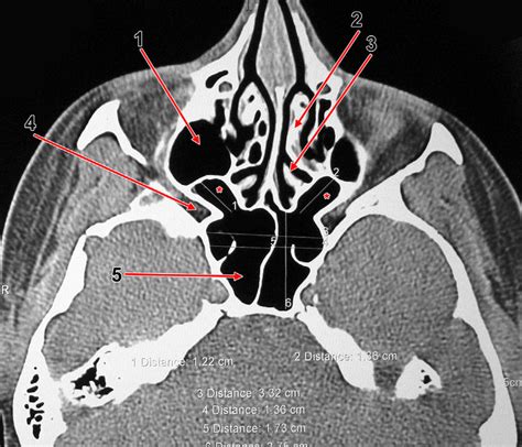 Maxillary Sinuses Anatomy