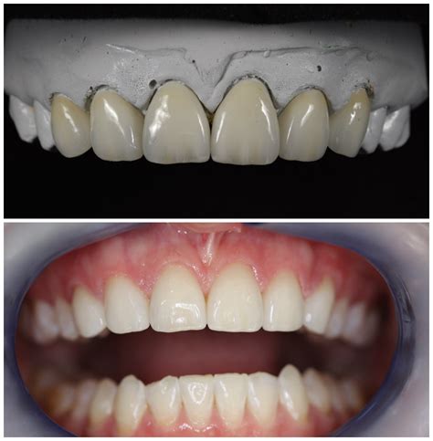 IPS Emax Crown | IPs Ivoclar Vivadent | Pindan Dental Lab