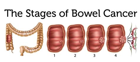 What is Bowel Cancer?