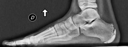 Sever disease (calcaneal apophysitis) | Radiology Case | Radiopaedia.org