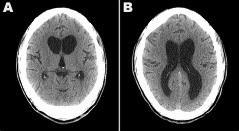 (A). The CT scan demonstrated caudate atrophy, suggestive of ...