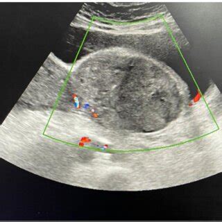 Retzius space hematoma. Transabdominal ultrasound shows Retzius ...