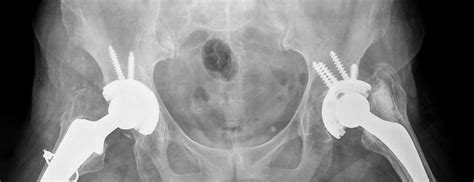 Hip Replacement Surgery | Johns Hopkins Medicine