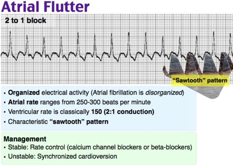 Atrial fibrillation vs flutter - Trosarab