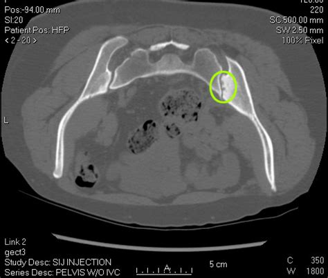 CT Pelvis to Rule Out Sacroiliitis | Cedars-Sinai