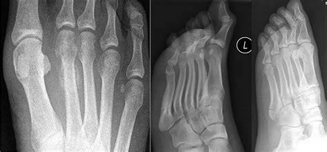 Further-X-rays-2-(foot-pain) - RCEMLearning