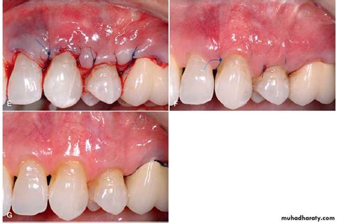 Mucogingival surgery pptx - د.هندرين - Muhadharaty