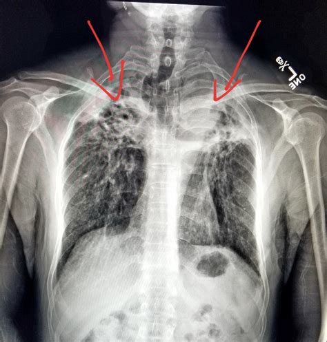 Pin on X-rays