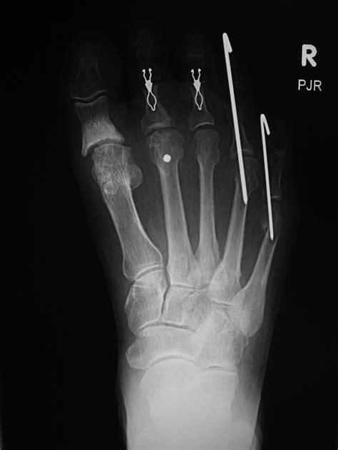 Fracture Fixation: a gallery