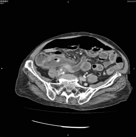 Figure 1 from Drainage of Periappendiceal Abscess and Removal of Free Fecalith—Extraperitoneal ...