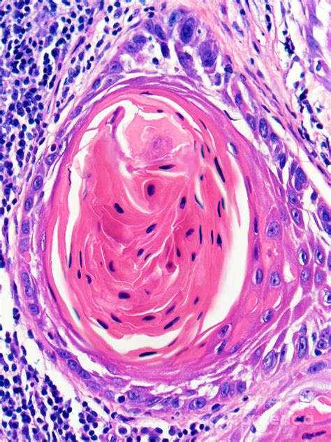 Squamous Cell Carcinoma Lung Keratin Pearls