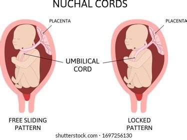 28 Nuchal Cord Images, Stock Photos, and Vectors | Shutterstock