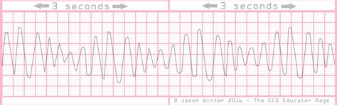 ECG Educator Blog : Polymorphic Ventricular Tachycardia (PVT)