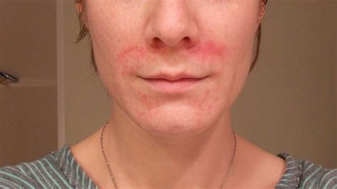 Itch or Non-Itchy Red Face Rash Causes and Treatments - American Celiac