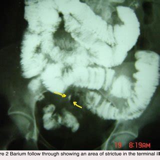 (PDF) Intestinal Tuberculosis