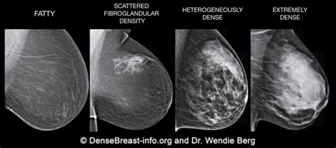 What is Density in the Breast? | Connecticut Breast Imaging