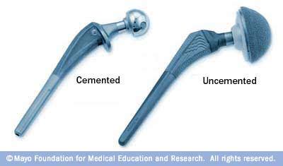 Two types of hip implants - Mayo Clinic