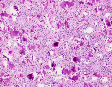 neuropathology blog: Juvenile psammomatoid ossifying fibroma in 22-year-old male with eyelid droop