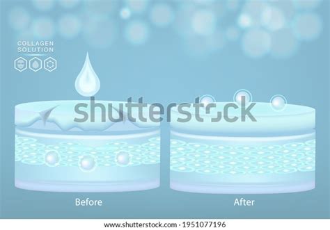 Hyaluronic Acid Before After Skin Solutions Stock Vector (Royalty Free) 1951077196 | Shutterstock