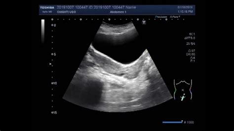 Didelphys Uterus Ultrasound