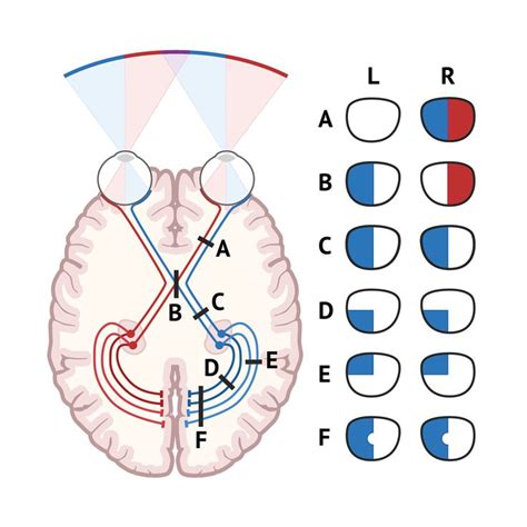 By identifying loss of vision in a particular field or group of fields, it is possible to ...