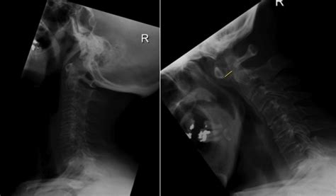 Atlanto-axial subluxation - Radiology at St. Vincent's University Hospital