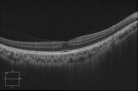 Foveal Hypoplasia Grade 1 Associated with Prematurity of Retinopathy - RetinaRA