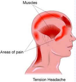 Tension Headache Treatment | Physio Professionals 3 Locations On The ...