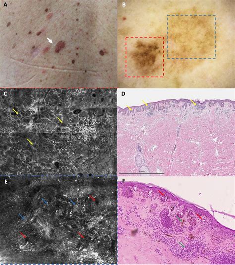 Severely dysplastic nevus (case #3). a Clinical panoramic view shows a ...