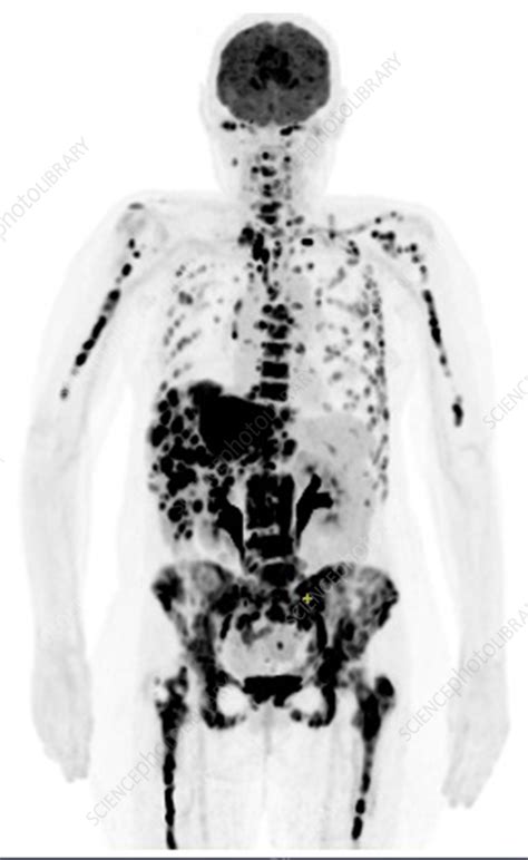 Metastatic breast cancer, PET scan - Stock Image - C055/8593 - Science ...