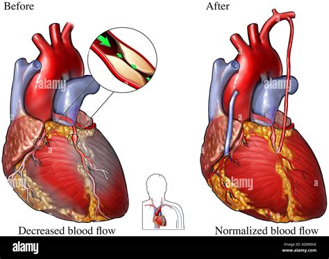 Coronary Artery Disease - Heart Bypass Surgery Stock Photo: 7710993 - Alamy