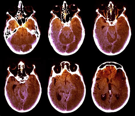 Brain With Alzheimer's Disease Photograph by Zephyr/science Photo ...