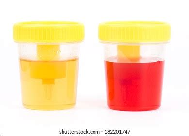 Bloody Urine Sample Sterileplastic Container Isolated Stock Photo 1032280801 | Shutterstock