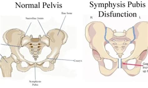 Symphysis Pubis Dysfunction: Causes, Symptoms Treatment, 44% OFF