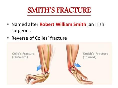 Smith Fracture - Kinetic Physical Therapy - Greenville, NC