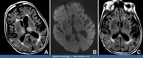 Hypertensive encephalopathy | MedLink Neurology