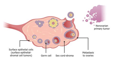 Ovarian Cancer Tumor Types