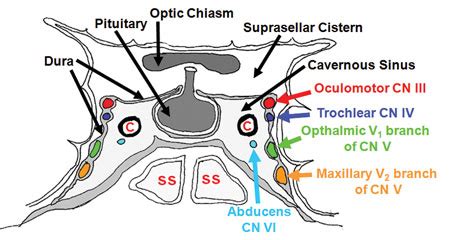 Cavernous Sinus Thrombosis-Signs symptoms-Diagnosis-Treatment and Complications | MedicoTips.Com