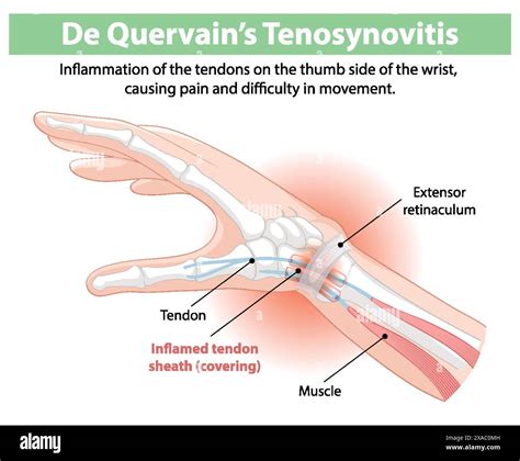 Inflammation of thumb tendons causing wrist pain Stock Vector Image & Art - Alamy