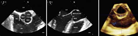 Aortic valve disease | Thoracic Key