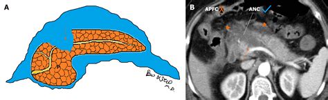 Acute pancreatitis: A pictorial review of early pancreatic fluid collections