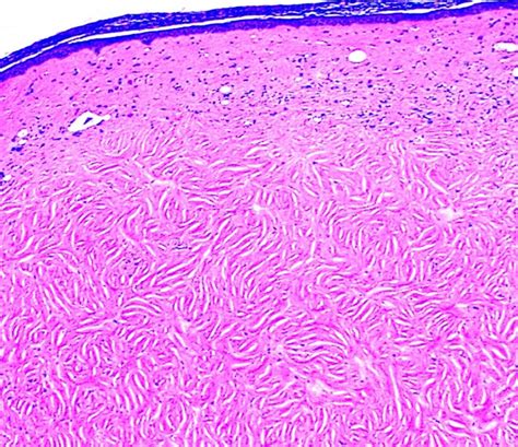 Pathology Outlines - Dermatofibroma / benign fibrous histiocytoma