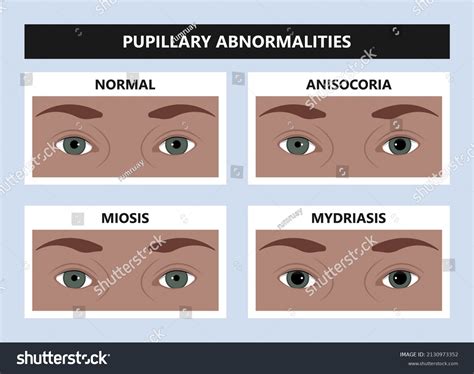 107 Constricted Pupils Images, Stock Photos & Vectors | Shutterstock